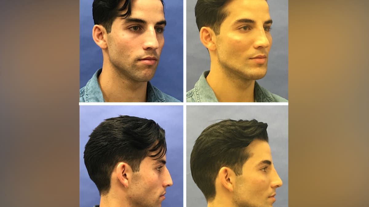 The Latest Uptick in Plastic Surgery: Procedures for Men