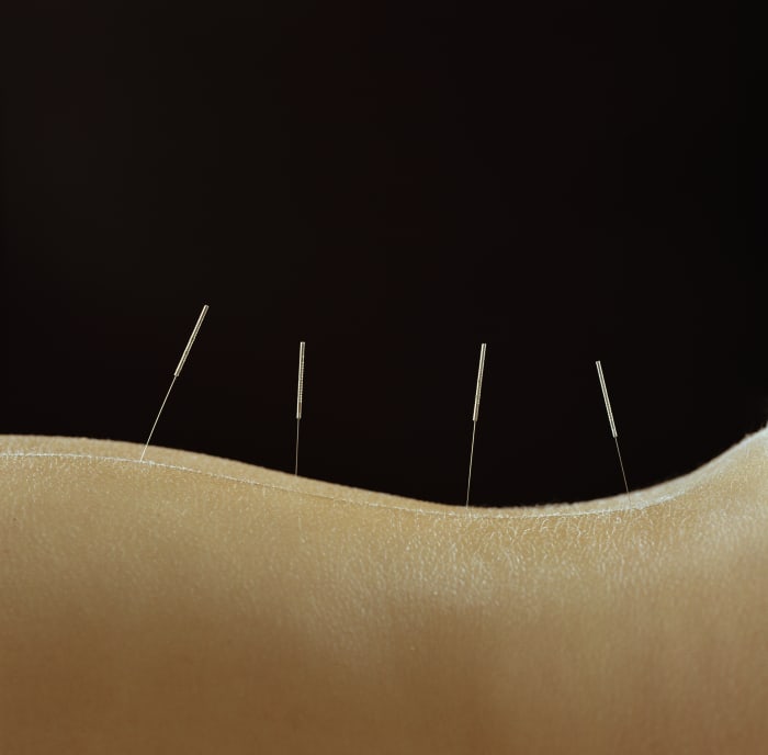 Three Things You Didn't Know Acupuncture Can Treat - Men's Journal