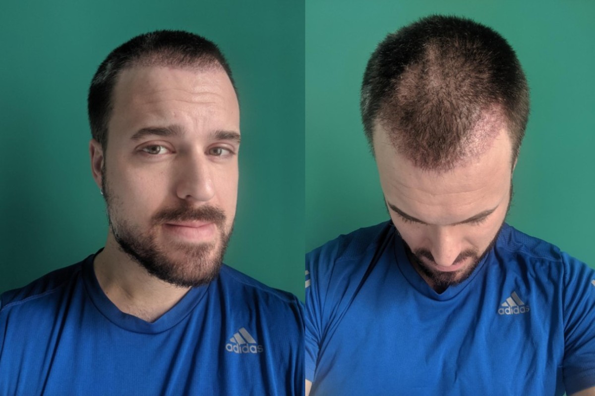 Hair Transplant Surgery Inside the Procedure and Results Men s