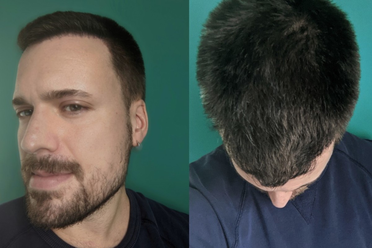 Hair Transplant Surgery Inside the Procedure and Results Men s