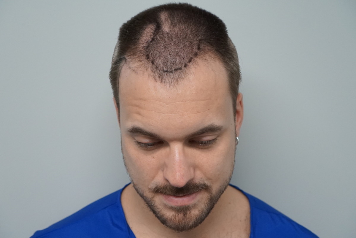 Hair Transplant Surgery Inside the Procedure and Results Men s