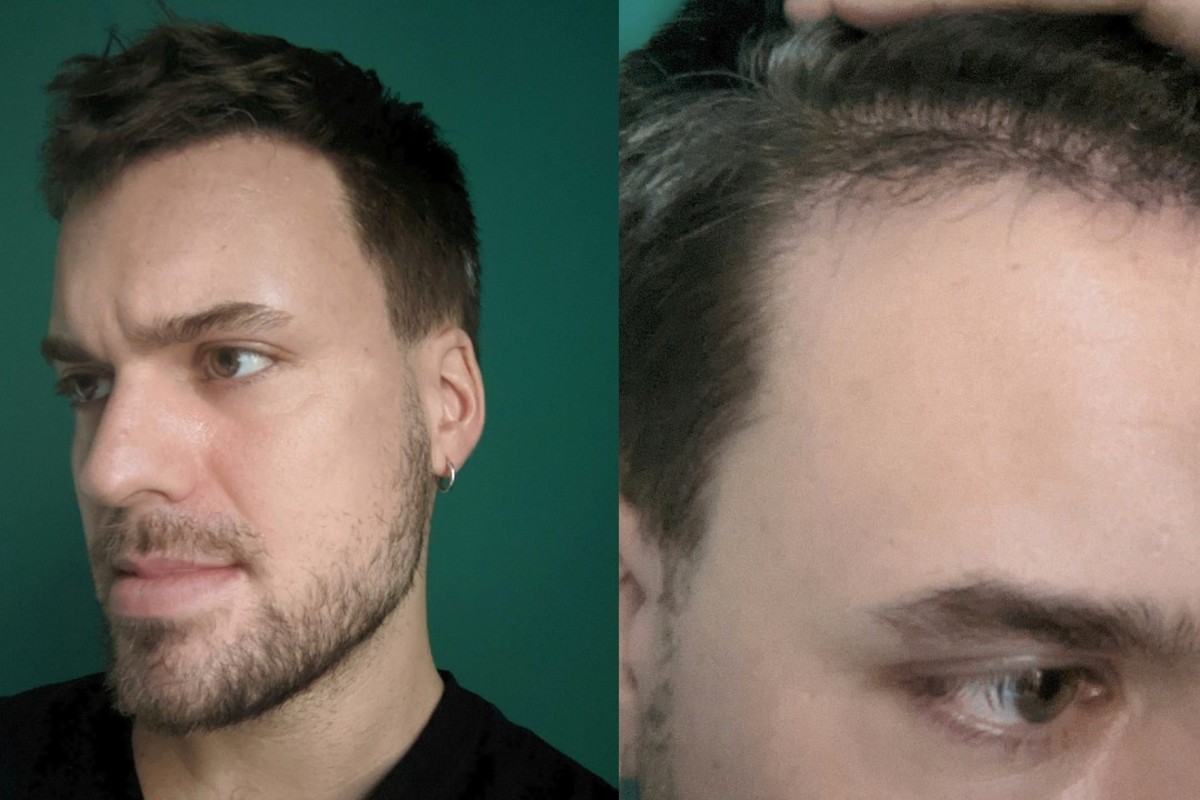 Hair Transplant Surgery Inside the Procedure and Results Men s