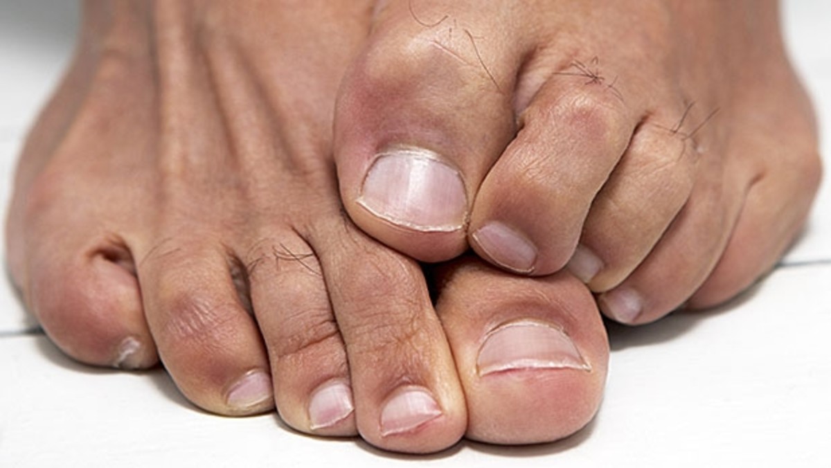 How to Cure Athlete's Foot - Men's Journal