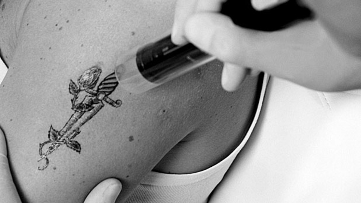 The Ultimate Guide to Laser Tattoo Removal | MEDermis Laser Clinic