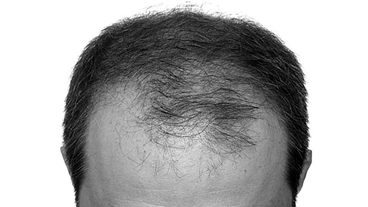 Can Thinning Hair Grow Back? Really? – Revela