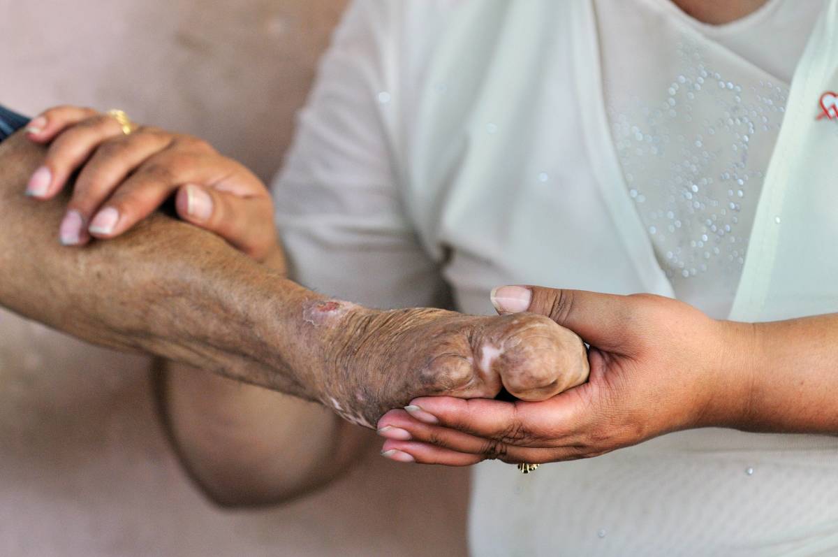 Leprosy ‘Endemic’ in Central Florida and Southeastern U.S