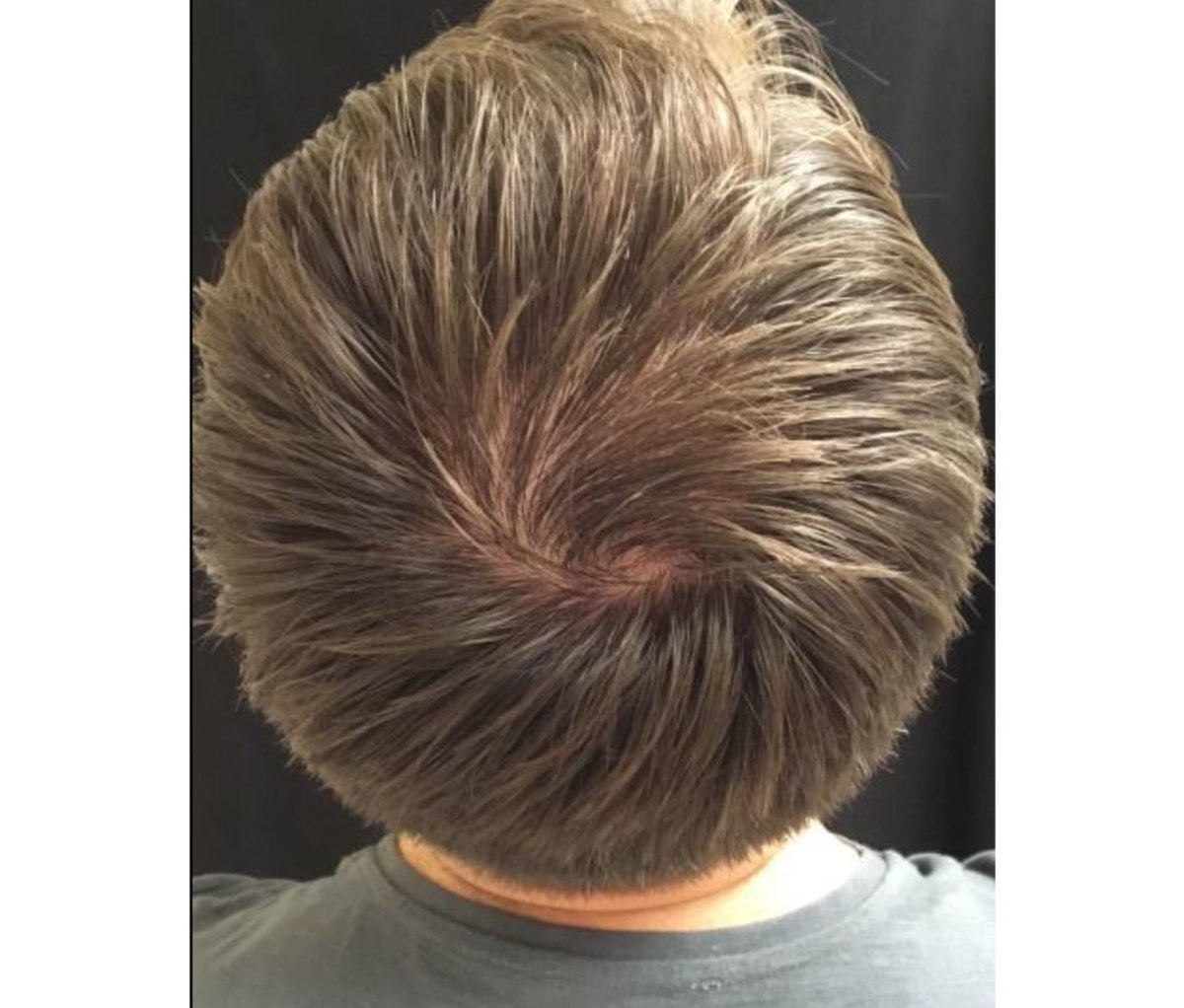 Prp For Hair Loss How Your Own Plasma Can Help Regrow Thinning Hair