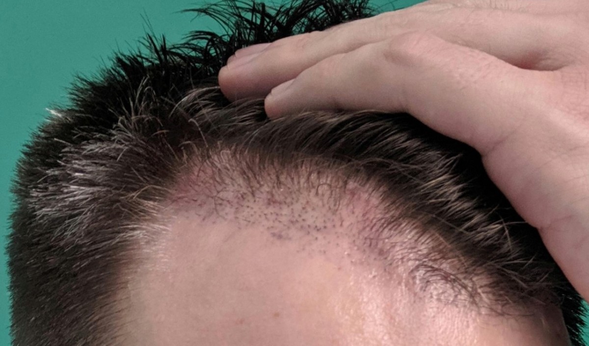 Hair transplant Adam Hurly surgery progress