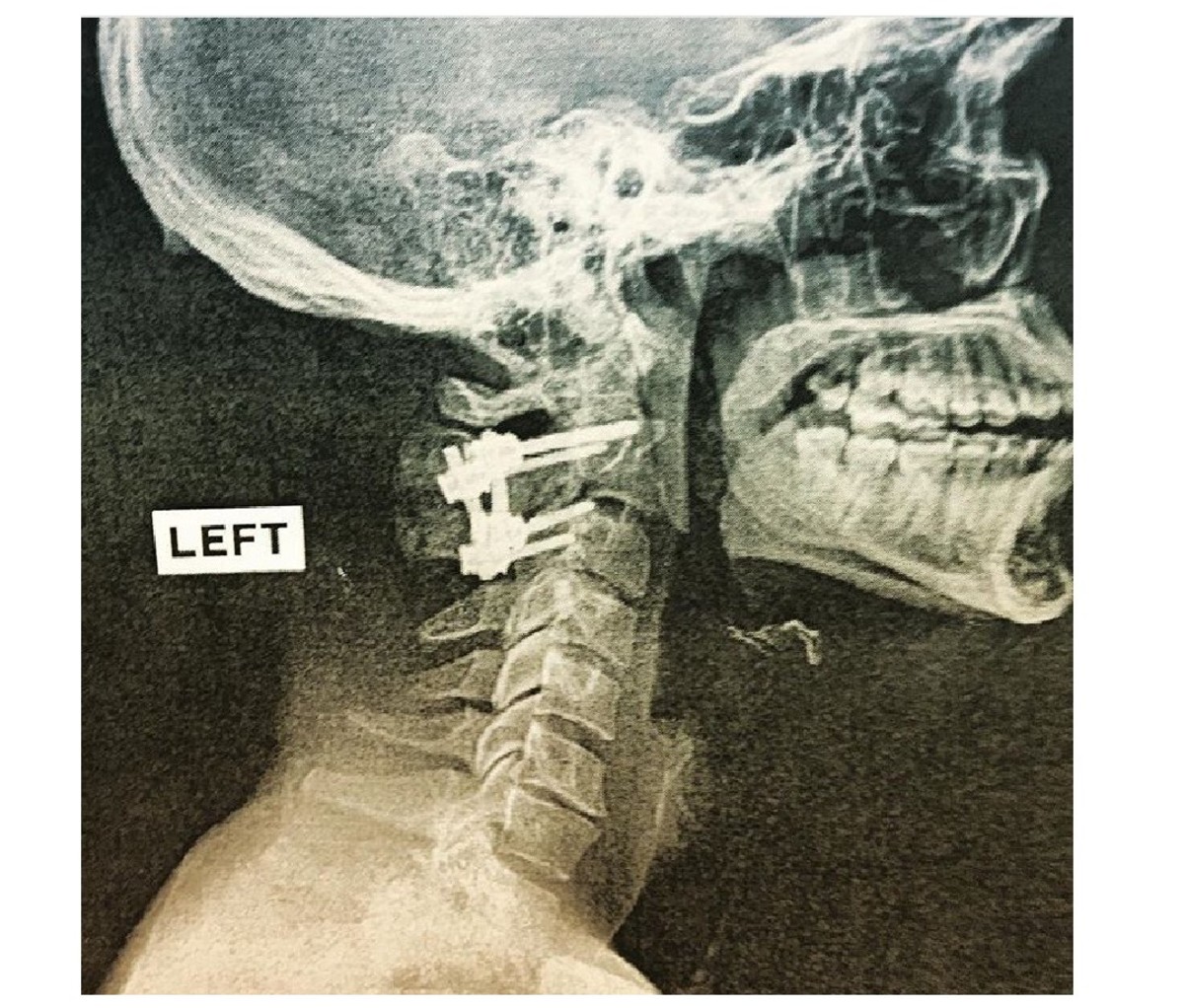 Skull profile of injured bull rider with spinal plate..